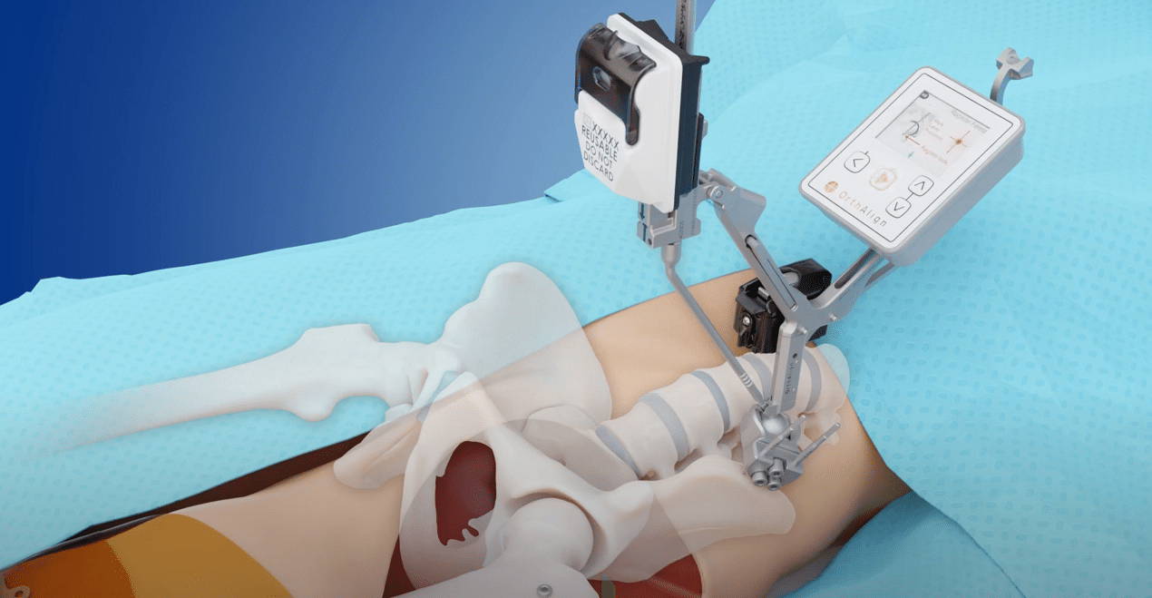 HipAlign® Supine Animation by OrthAlign